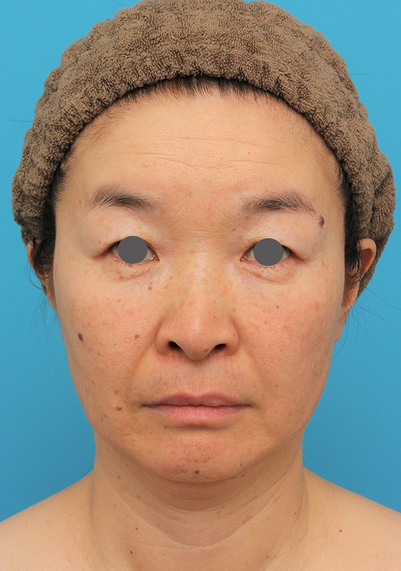 症例写真,フェイスリフトでたるみをリフトアップさせた50代後半女性の症例写真,Before,ba_facelift006_b01.jpg