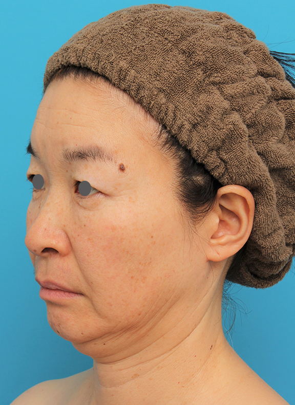 症例写真,フェイスリフトでたるみをリフトアップさせた50代後半女性の症例写真,Before,ba_facelift006_b02.jpg