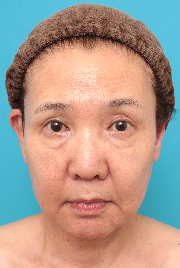 フルフェイスリフト,フルフェイスリフトを行った60代女性の症例写真,Before,ba_facelift007_b01.jpg