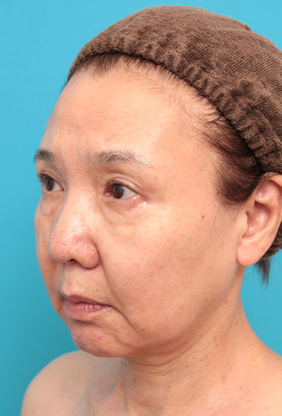 フルフェイスリフト,フルフェイスリフトを行った60代女性の症例写真,Before,ba_facelift007_b02.jpg