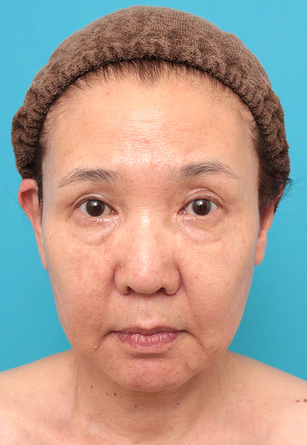 フルフェイスリフト,フルフェイスリフトを行った60代女性の症例写真,手術前,mainpic_facelift007a.jpg