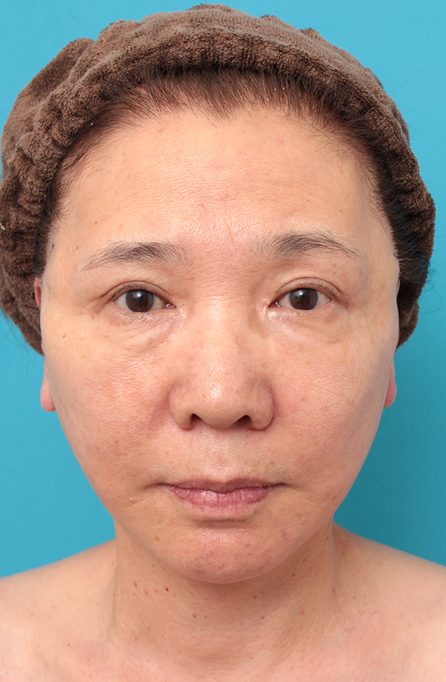 症例写真,フルフェイスリフトを行った60代女性の症例写真,手術直後,mainpic_facelift007b.jpg