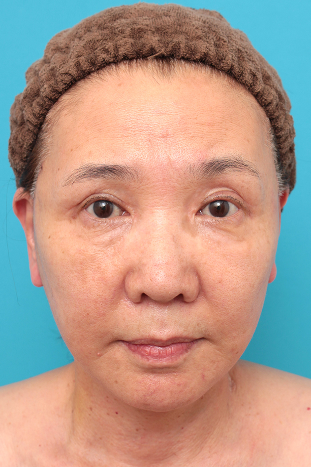 フルフェイスリフト,フルフェイスリフトを行った60代女性の症例写真,1週間後,mainpic_facelift007c.jpg