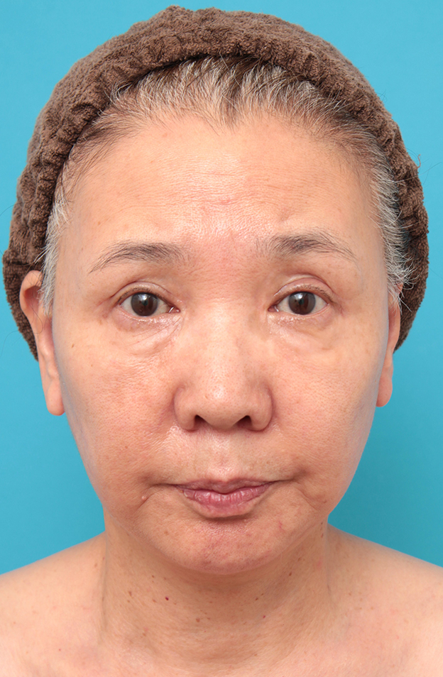 症例写真,フルフェイスリフトを行った60代女性の症例写真,3週間後,mainpic_facelift007d.jpg
