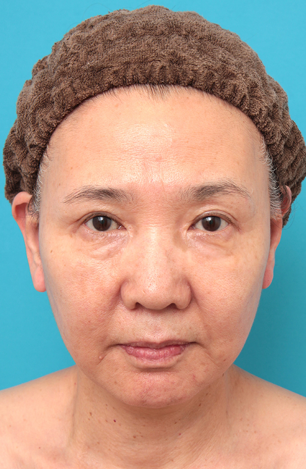 フルフェイスリフト,フルフェイスリフトを行った60代女性の症例写真,6ヶ月後,mainpic_facelift007e.jpg