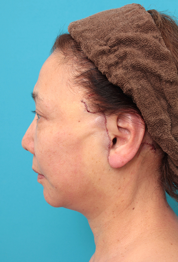 フルフェイスリフト,フルフェイスリフトを行った60代女性の症例写真,手術直後,mainpic_facelift007g.jpg