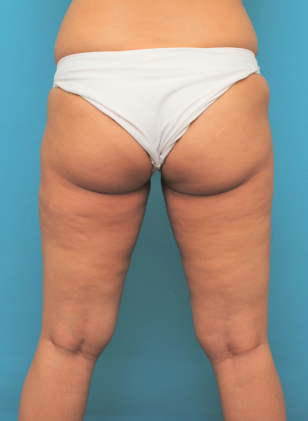 症例写真,脂肪吸引の症例 お尻と太ももの脂肪吸引とバスト脂肪注入の30代女性,6ヶ月後,mainpic_shibokyuin045j.jpg