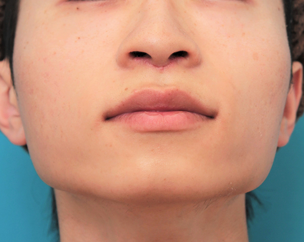症例写真,人中短縮手術（リップリフト）で鼻の下を短くした20代男性の症例写真,6日後,mainpic_hanashita007h.jpg