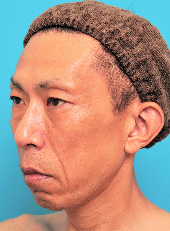 症例写真,ミディアムフェイスリフトでリフトアップした50代男性の症例写真,Before,ba_mediumlift018_b02.jpg