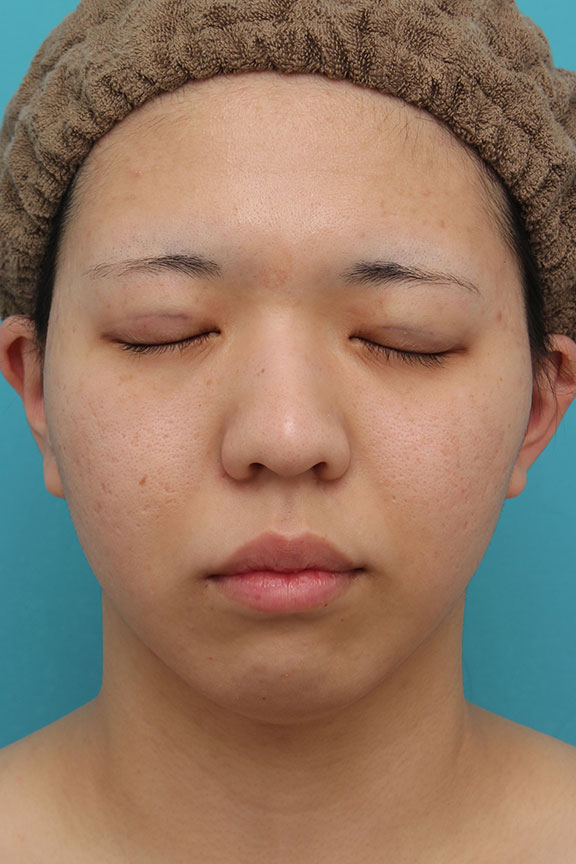 症例写真,裏留め埋没法の症例写真,After（メイクなし）<br/>
（施術直後）,ba_maibotsu2001_b02.jpg