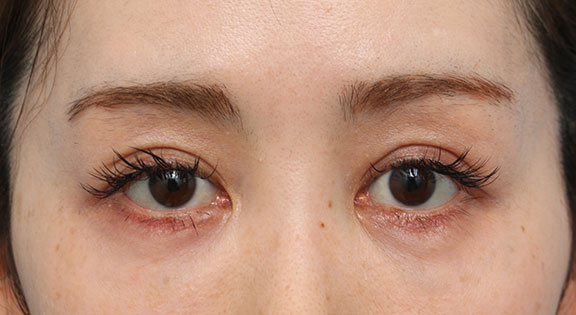 くぼみ目修正（ヒアルロン酸注射） ヒアルロン酸の注入でくぼみ目を修正した患者様の症例,After,ba_kubomi011_a01.jpg