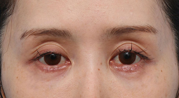 くぼみ目修正（ヒアルロン酸注射） ヒアルロン酸の注入でくぼみ目を修正した患者様の症例,Before,ba_kubomi011_b01.jpg