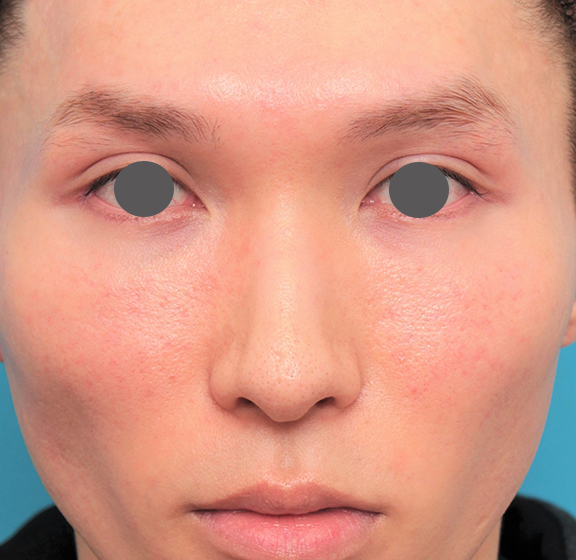 症例写真,鼻骨切り幅寄せ+小鼻縮小+鼻尖縮小+鼻先の耳介軟骨移植を行った20代男性の症例写真,After（6ヶ月後）,ba_honekiri011_b01.jpg