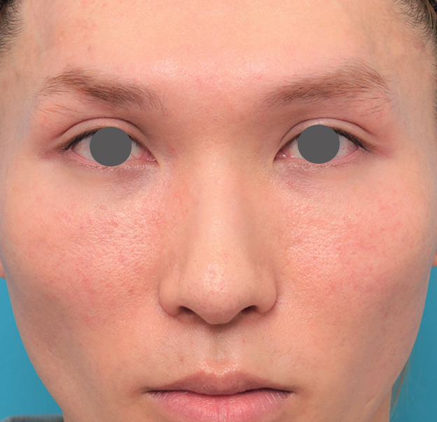 症例写真,鼻骨切り幅寄せ+小鼻縮小+鼻尖縮小+鼻先の耳介軟骨移植を行った20代男性の症例写真,2ヶ月後,mainpic_honekiri011e.jpg