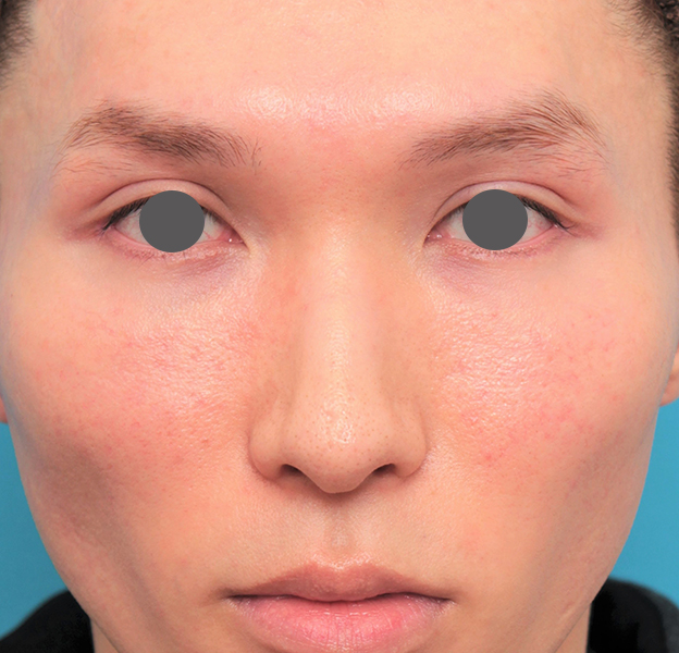 症例写真,鼻骨切り幅寄せ+小鼻縮小+鼻尖縮小+鼻先の耳介軟骨移植を行った20代男性の症例写真,6ヶ月後,mainpic_honekiri011f.jpg