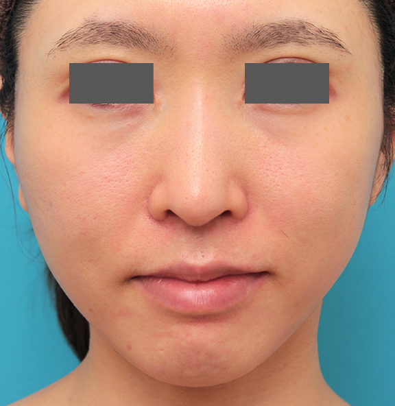 小鼻縮小と人中短縮を同時に行った30代女性の症例写真,After（6ヶ月後）,ba_biyoku053_a01.jpg