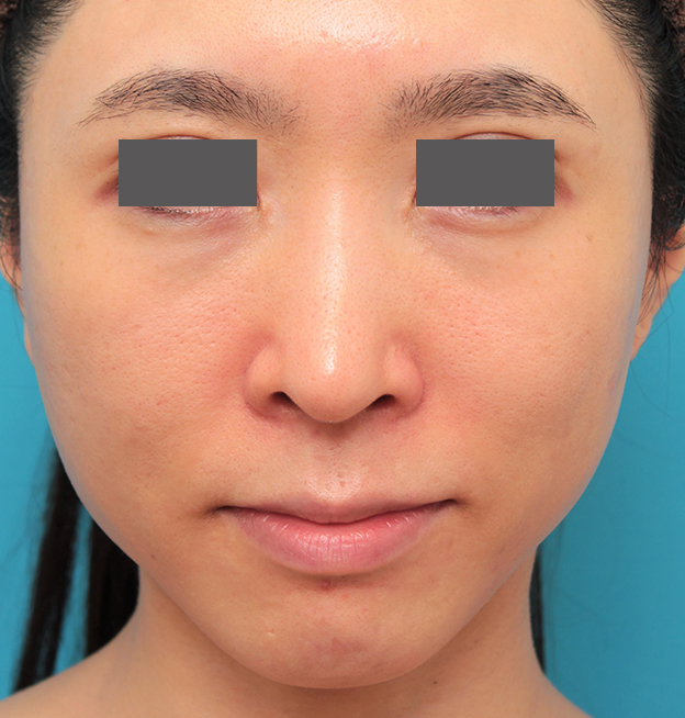 症例写真,小鼻縮小と人中短縮を同時に行った30代女性の症例写真,手術前,mainpic_biyoku053a.jpg