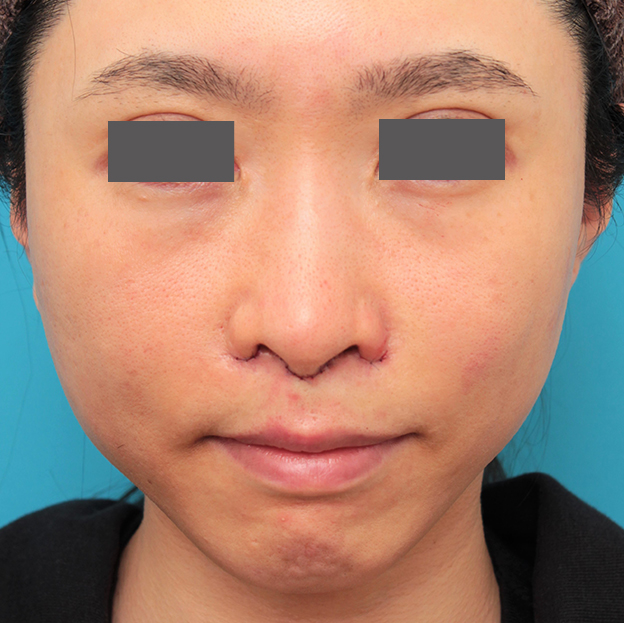 症例写真,小鼻縮小と人中短縮を同時に行った30代女性の症例写真,手術直後,mainpic_biyoku053b.jpg