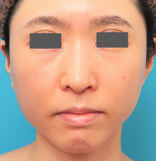 症例写真,小鼻縮小と人中短縮を同時に行った30代女性の症例写真,6日後,mainpic_biyoku053c.jpg