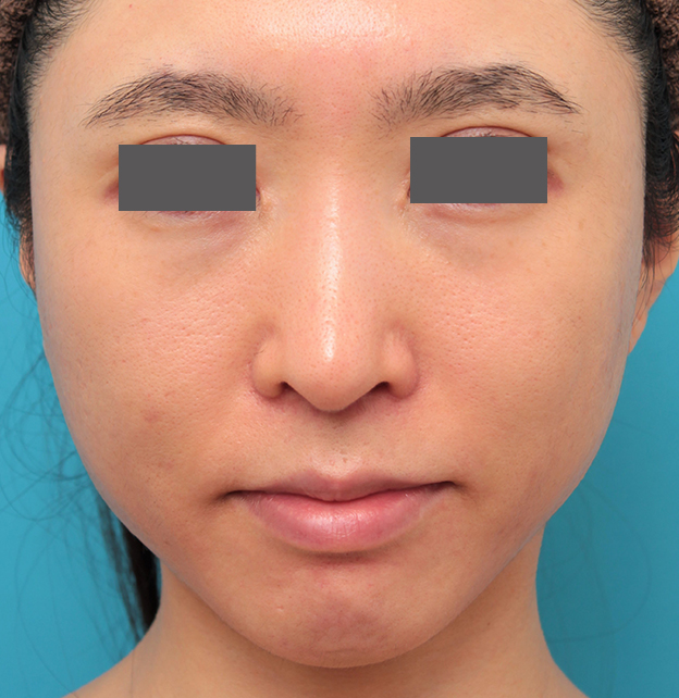症例写真,小鼻縮小と人中短縮を同時に行った30代女性の症例写真,3週間後,mainpic_biyoku053d.jpg