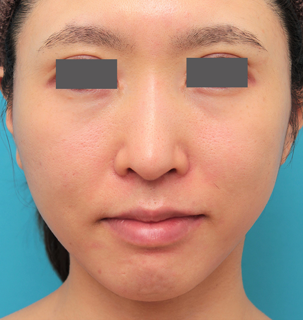 症例写真,小鼻縮小と人中短縮を同時に行った30代女性の症例写真,6ヶ月後,mainpic_biyoku053f.jpg