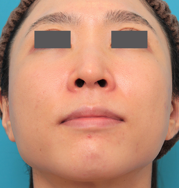 症例写真,小鼻縮小と人中短縮を同時に行った30代女性の症例写真,手術前,mainpic_biyoku053g.jpg