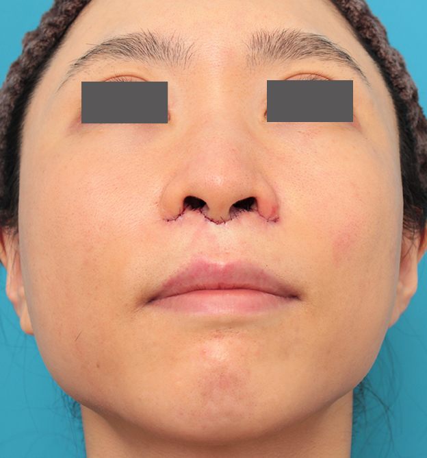 症例写真,小鼻縮小と人中短縮を同時に行った30代女性の症例写真,手術直後,mainpic_biyoku053h.jpg