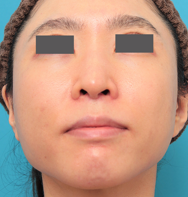 症例写真,小鼻縮小と人中短縮を同時に行った30代女性の症例写真,3週間後,mainpic_biyoku053j.jpg