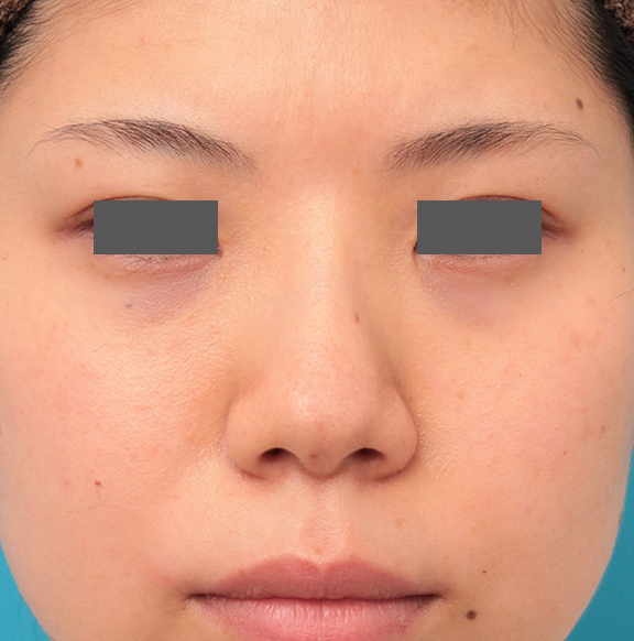 隆鼻注射（ヒアルロン酸注射）,長期持続型ヒアルロン酸を鼻筋に注射した20代女性の症例写真,After（6ヶ月後）,ba_ryubi2042_b01.jpg