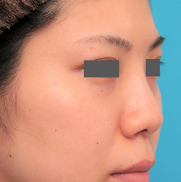 隆鼻注射（ヒアルロン酸注射）,長期持続型ヒアルロン酸を鼻筋に注射した20代女性の症例写真,After（6ヶ月後）,ba_ryubi2042_b02.jpg
