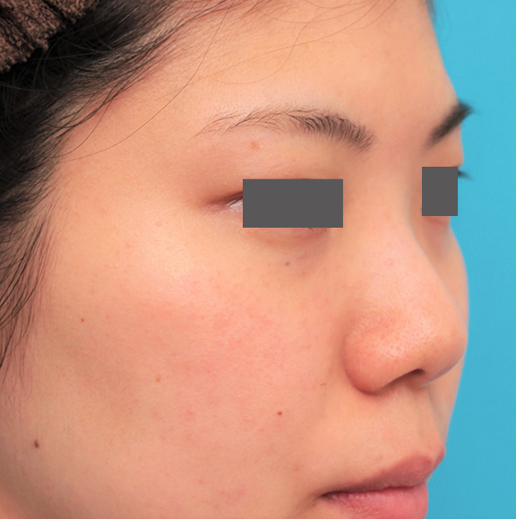 隆鼻注射（ヒアルロン酸注射）,長期持続型ヒアルロン酸を鼻筋に注射した20代女性の症例写真,Before,ba_ryubi2042_b02.jpg