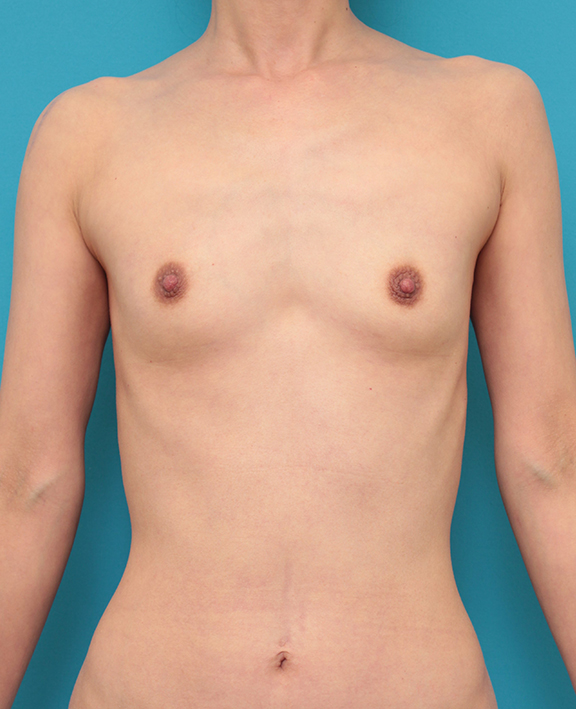 乳腺下に140ccのシリコンバッグプロテーゼを入れた40代女性の症例写真,Before,ba_hokyo037_b01.jpg