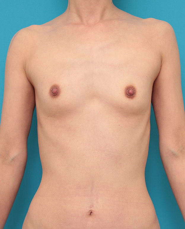 症例写真,乳腺下に140ccのシリコンバッグプロテーゼを入れた40代女性の症例写真,手術前,mainpic_hokyo037a.jpg