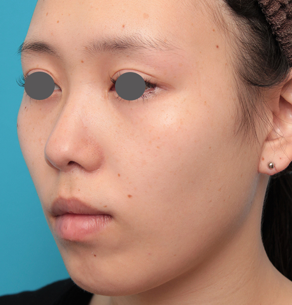 耳介軟骨移植（鼻先を出す）,人中短縮+小鼻縮小+耳介軟骨移植を行った20代女性の症例写真,After（6ヶ月後）,ba_hanashita008_b02.jpg