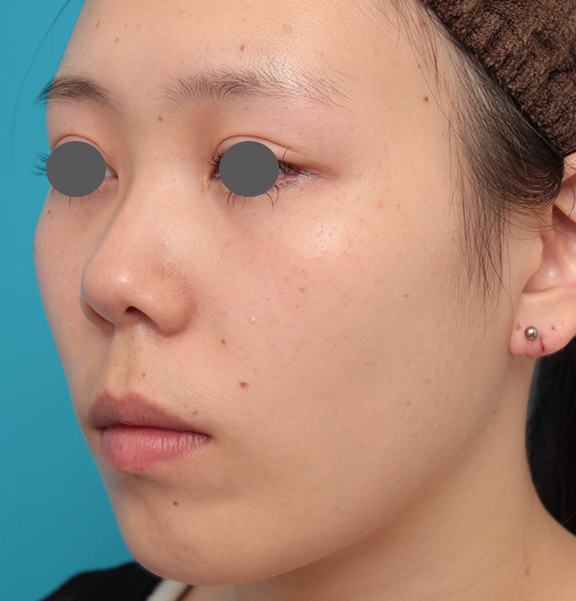 鼻の下を短く（上口唇短縮手術、上口唇リフト、リップリフト、人中短縮術）,人中短縮+小鼻縮小+耳介軟骨移植を行った20代女性の症例写真,Before,ba_hanashita008_b02.jpg