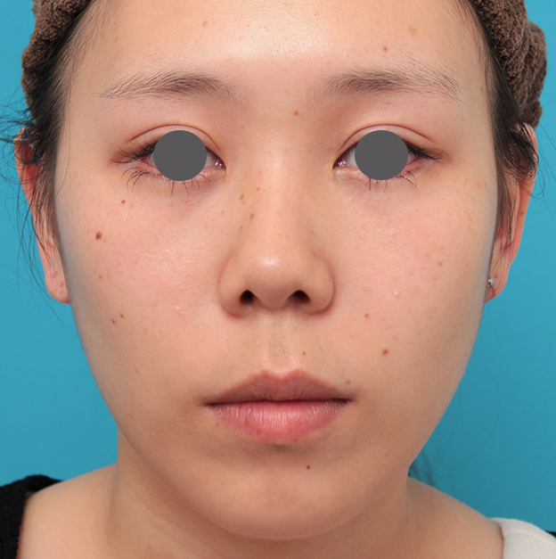 症例写真,人中短縮+小鼻縮小+耳介軟骨移植を行った20代女性の症例写真,手術前,mainpic_hanashita008a.jpg