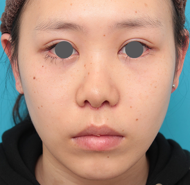症例写真,人中短縮+小鼻縮小+耳介軟骨移植を行った20代女性の症例写真,6日後,mainpic_hanashita008c.jpg