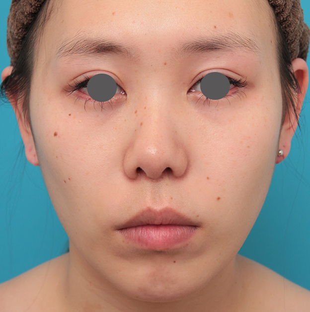 鼻の下を短く（上口唇短縮手術、上口唇リフト、リップリフト、人中短縮術）,人中短縮+小鼻縮小+耳介軟骨移植を行った20代女性の症例写真,3週間後,mainpic_hanashita008d.jpg