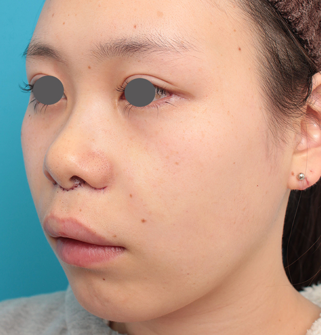 耳介軟骨移植（鼻先を出す）,人中短縮+小鼻縮小+耳介軟骨移植を行った20代女性の症例写真,手術直後,mainpic_hanashita008g.jpg