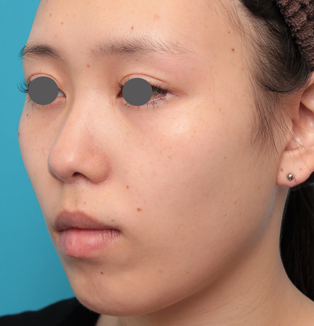 鼻の下を短く（上口唇短縮手術、上口唇リフト、リップリフト、人中短縮術）,人中短縮+小鼻縮小+耳介軟骨移植を行った20代女性の症例写真,6ヶ月後,mainpic_hanashita008j.jpg
