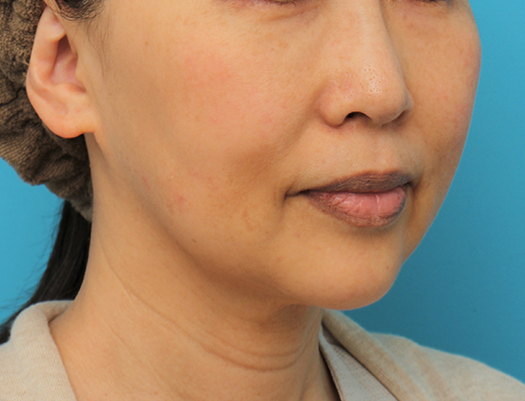 あご形成（シリコンプロテーゼ）,顎にシリコンプロテーゼを入れた50代後半女性の症例写真,After（6ヶ月後）,ba_ago024_b02.jpg