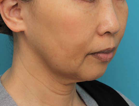 症例写真,顎にシリコンプロテーゼを入れた50代後半女性の症例写真,Before,ba_ago024_b02.jpg