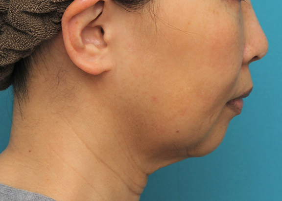症例写真,顎にシリコンプロテーゼを入れた50代後半女性の症例写真,Before,ba_ago024_b03.jpg