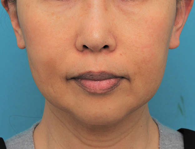 症例写真,顎にシリコンプロテーゼを入れた50代後半女性の症例写真,手術前,mainpic_ago024a.jpg