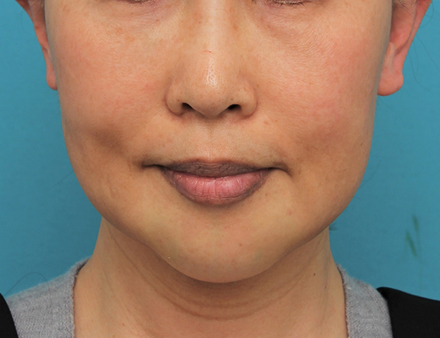 症例写真,顎にシリコンプロテーゼを入れた50代後半女性の症例写真,手術直後,mainpic_ago024b.jpg