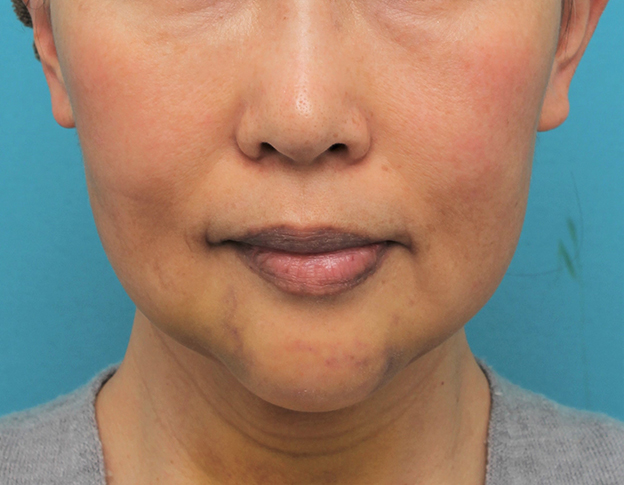 症例写真,顎にシリコンプロテーゼを入れた50代後半女性の症例写真,5日後,mainpic_ago024c.jpg