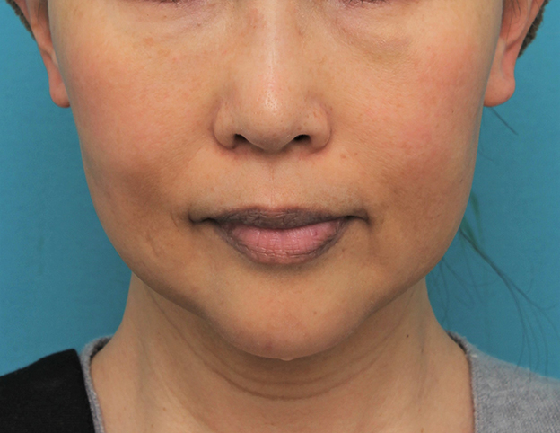 症例写真,顎にシリコンプロテーゼを入れた50代後半女性の症例写真,3週間後,mainpic_ago024d.jpg