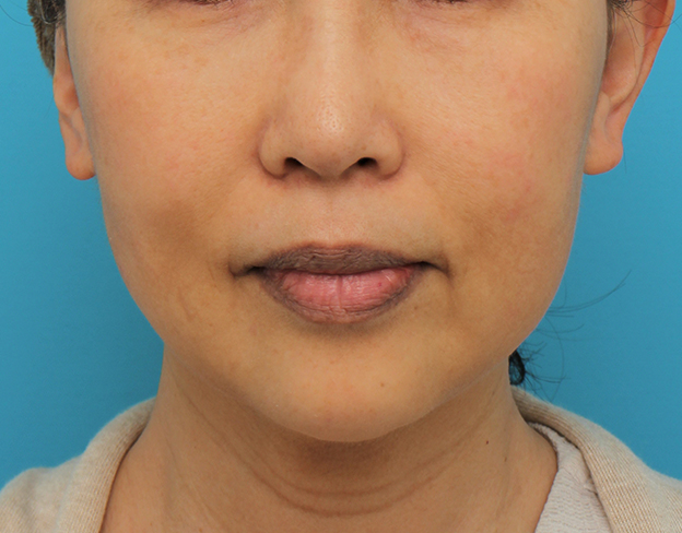 症例写真,顎にシリコンプロテーゼを入れた50代後半女性の症例写真,6ヶ月後,mainpic_ago024e.jpg
