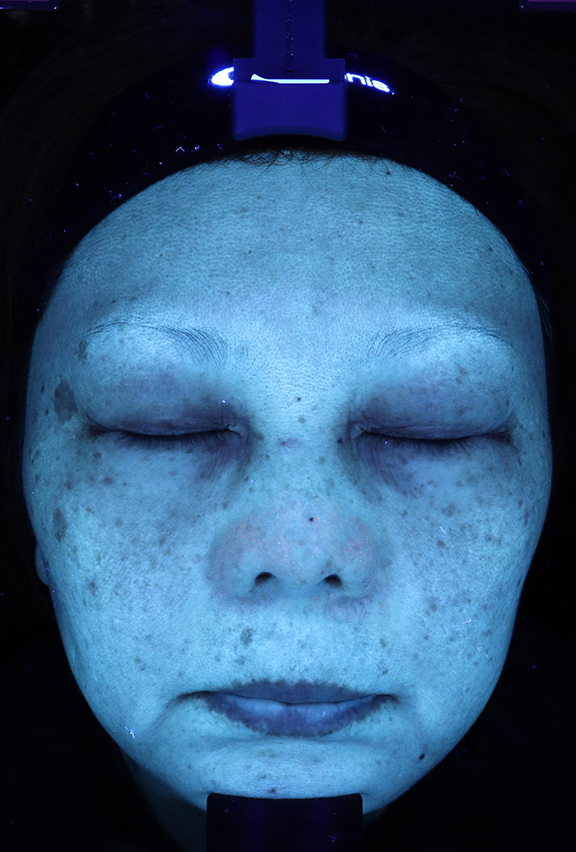症例写真,ピコレーザーで治療した症例写真,Before,ba_picoway002_b02.jpg