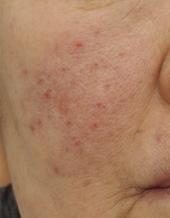 症例写真,ポテンツァで赤ら顔の治療を行った症例写真,After（3回目の施術から2週間後）,ba_potenza001_b01.jpg